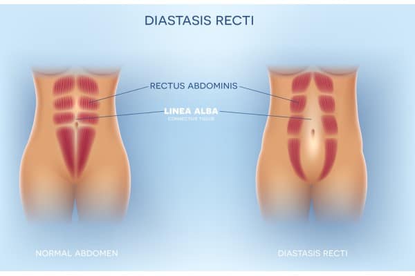 What Non-Surgical Options Are Available for Diastasis Recti Stanford le Hope?