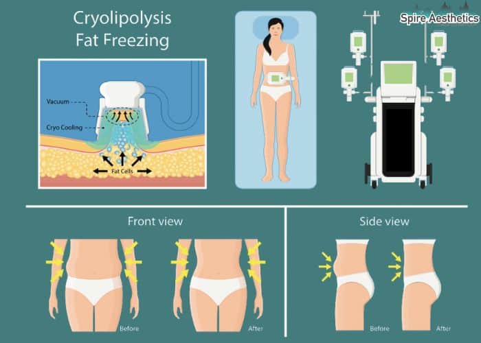 Image of diet and fat freezing combined for best results for Spire Aesthetics Stanford le Hope