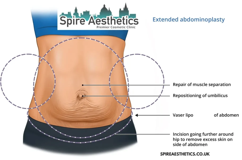 Understanding Loose Skin After Gastric Band Stanford le Hope Surgery and HIFU Treatment 