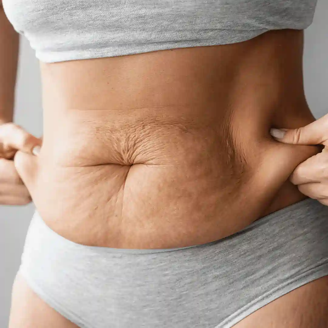 Is It Normal to Have Loose Skin After Pregnancy Stanford le Hope?