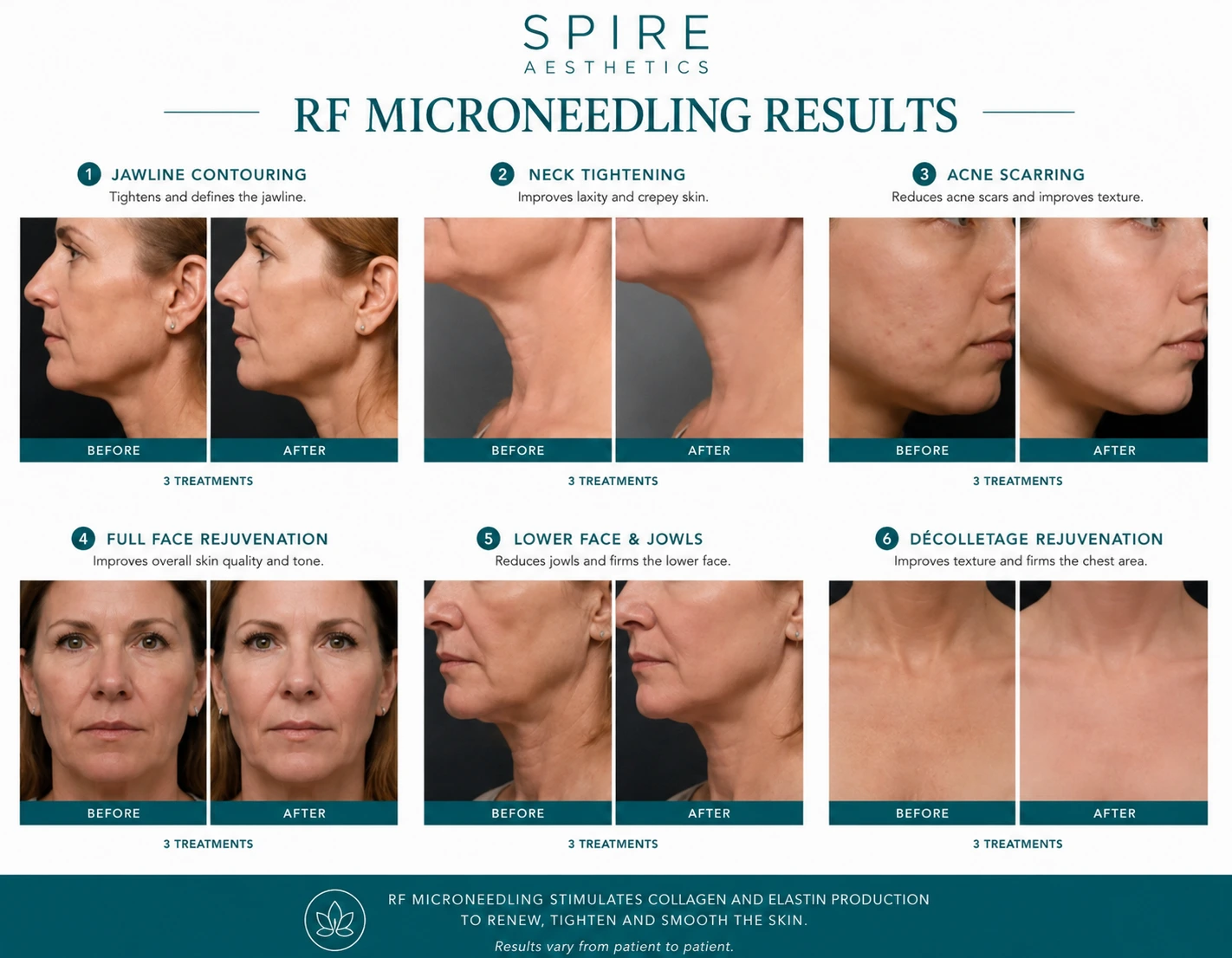 RF Microneedling Skin tightening Stanford le Hope results