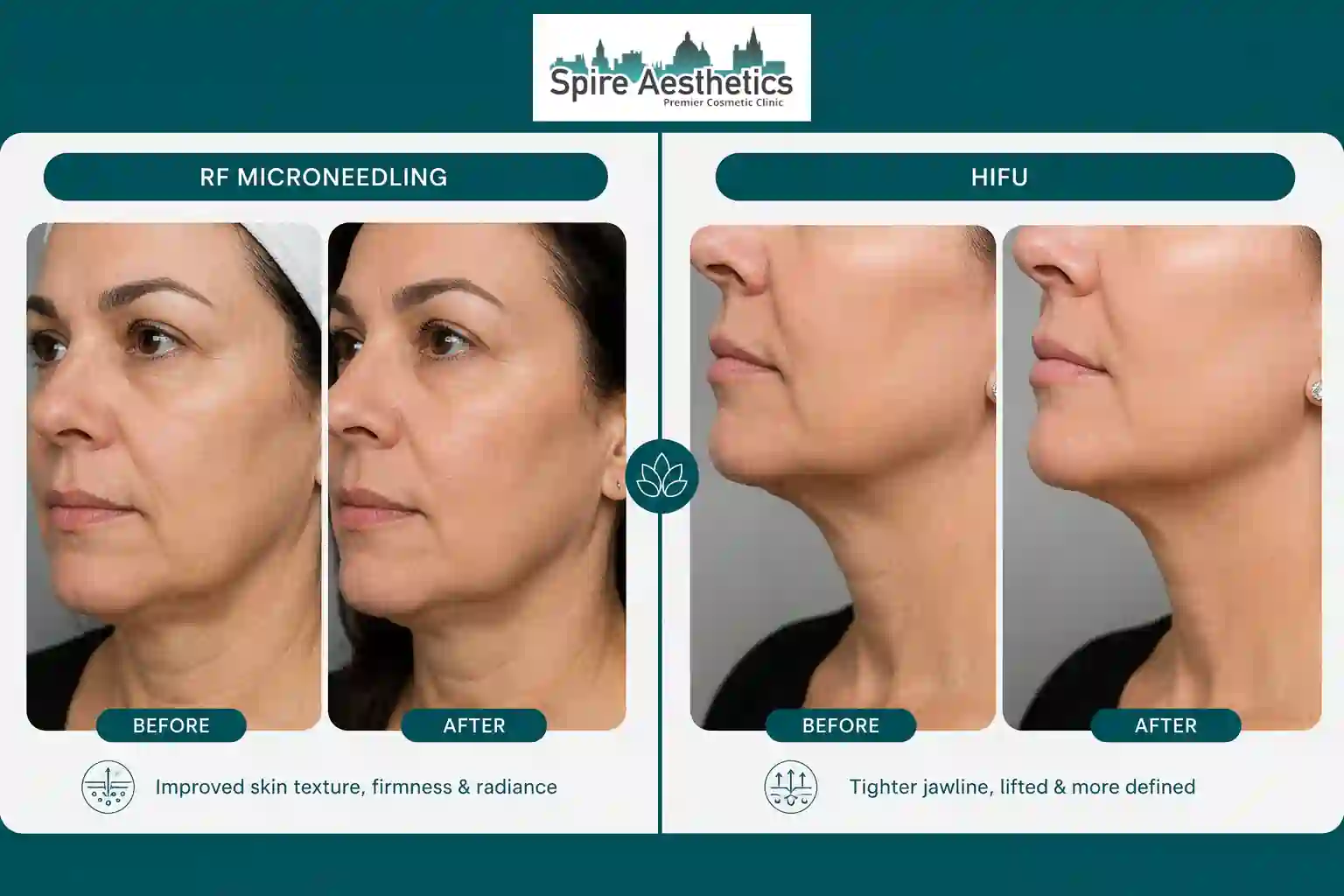 Can RF Microneedling and HIFU Be Combined Stanford le Hope?