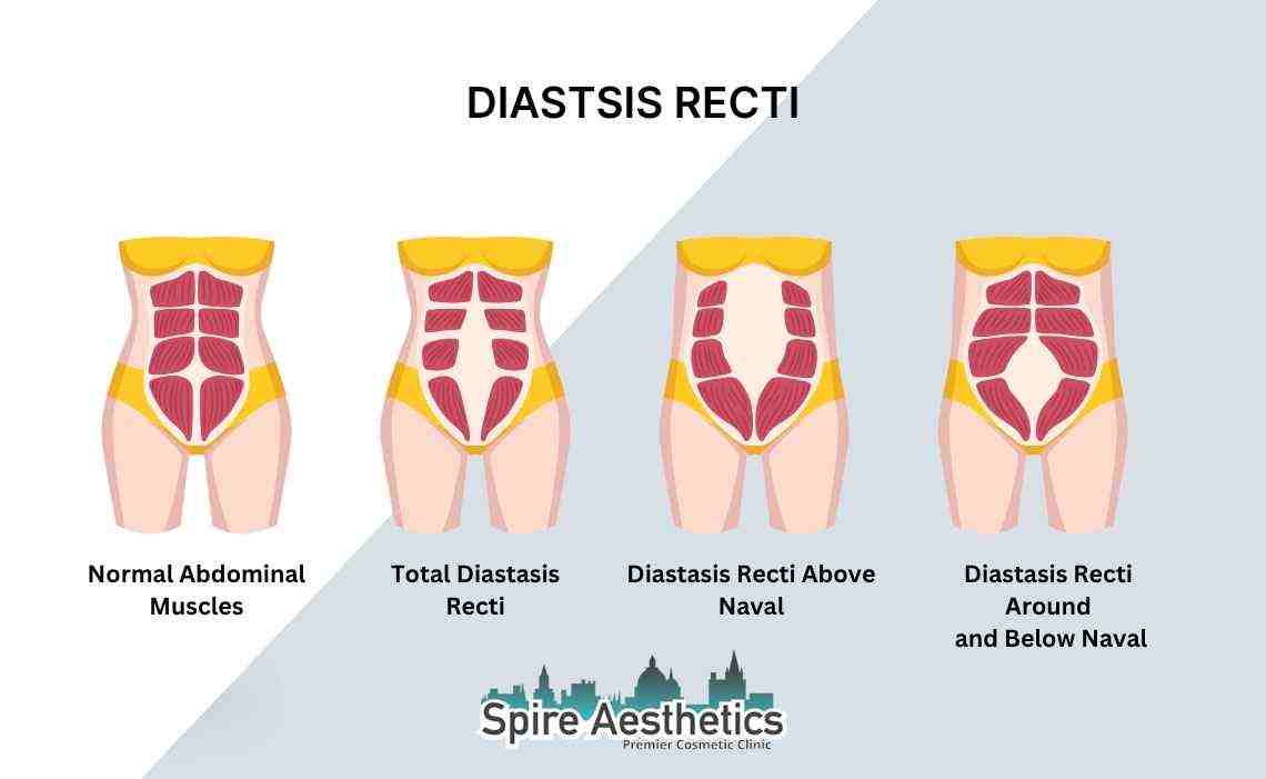 Is Non-Surgical Diastasis Recti Treatment Right for You? Common Concerns Answered Stanford le Hope